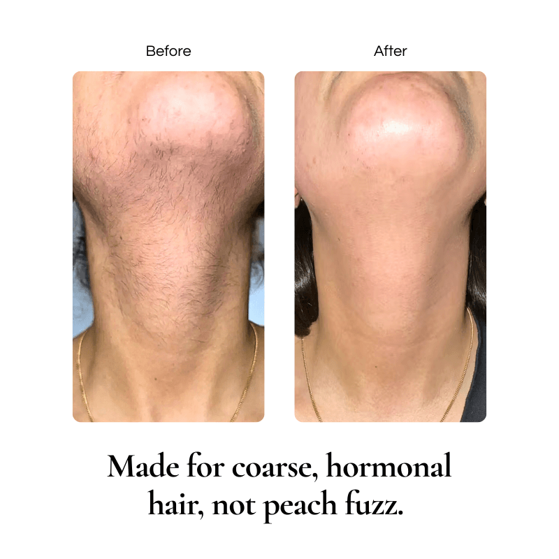 Before and after results of Belluxe™ facial hair trimmer on coarse chin hair caused by PCOS.